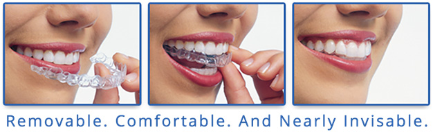 Invisalign